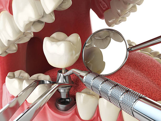 Best Emergency Root Canal Treatment in Monticello, LA